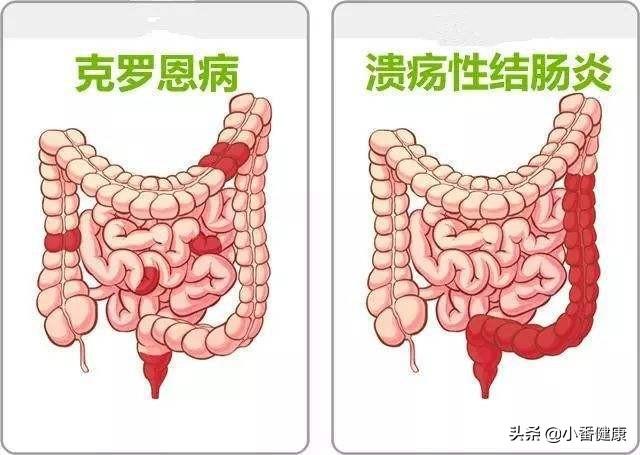 甲亢最新研究进展，从病理机制到治疗策略的革新